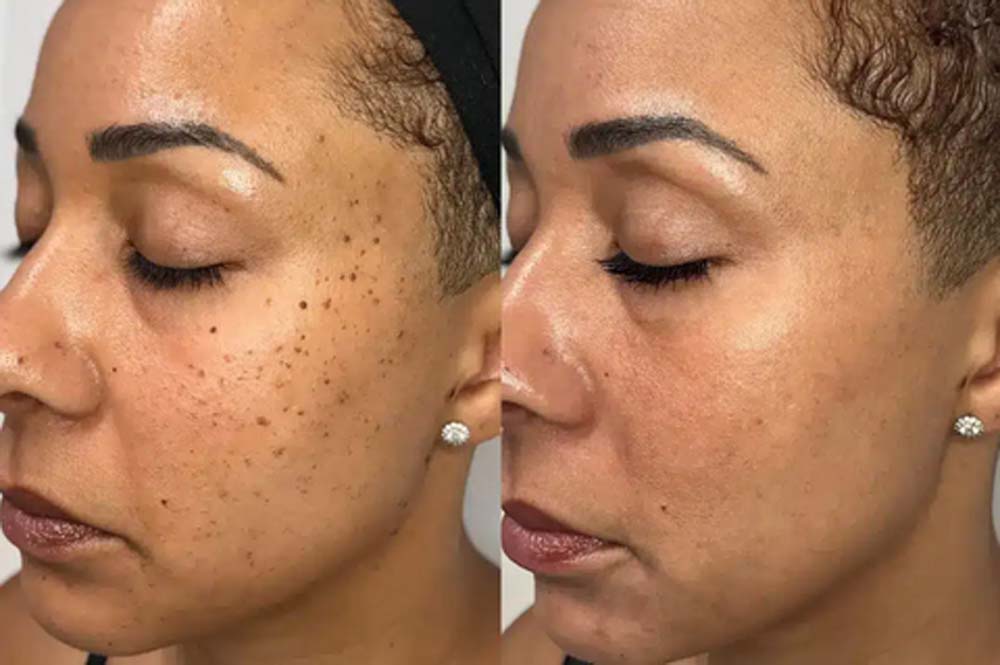 Hermsa® non-invasive laser pointer - mole and wart removal (🔥Last day 50% off)