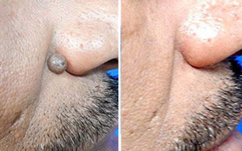 Hermsa® non-invasive laser pointer - mole and wart removal (🔥Last day 50% off)