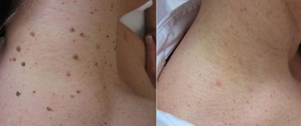 Hermsa® non-invasive laser pointer - mole and wart removal (🔥Last day 50% off)