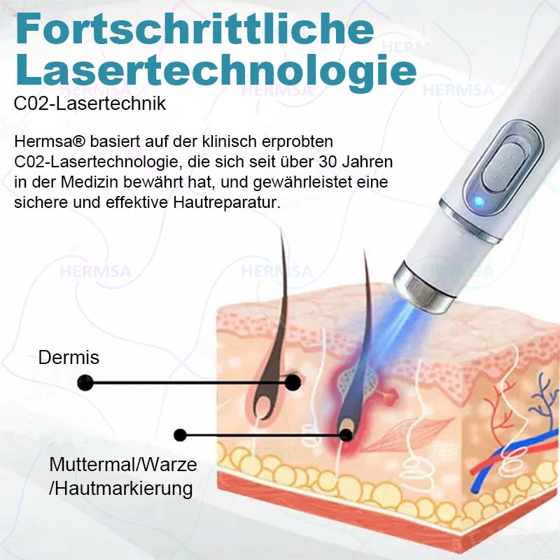 Hermsa® non-invasive laser pointer - mole and wart removal (🔥Last day 50% off)