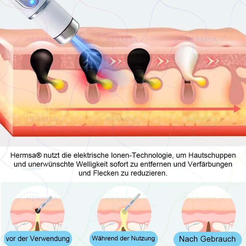 Hermsa® non-invasive laser pointer - mole and wart removal (🔥Last day 50% off)