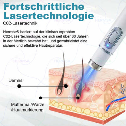 Hermsa® non-invasive laser pointer - mole and wart removal (🔥Last day 50% off)